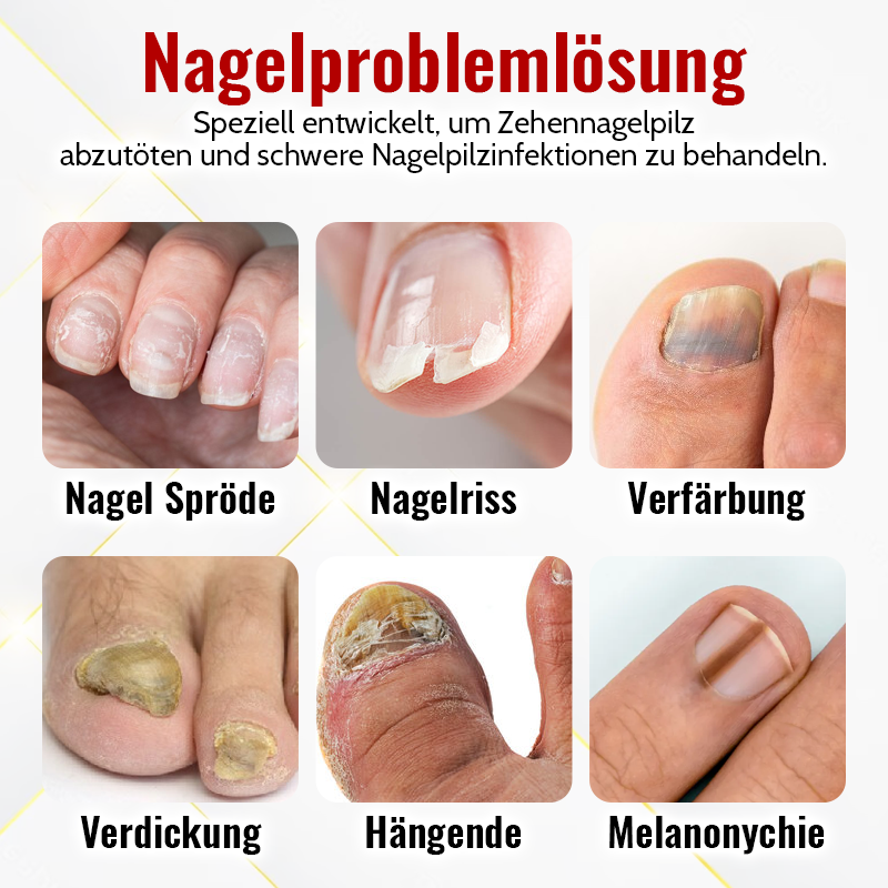 1+1 Gratis | NailSaver - Onychomykose Rapid Relief Olie